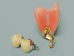 マルチコン・奥歯のアタッチメント式入れ歯・麻布十番の歯科
